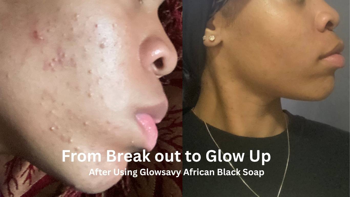 Glowsavy African Black Soap 5.2 oz – Handmade in Ghana, Fights Acne & Dark Spots